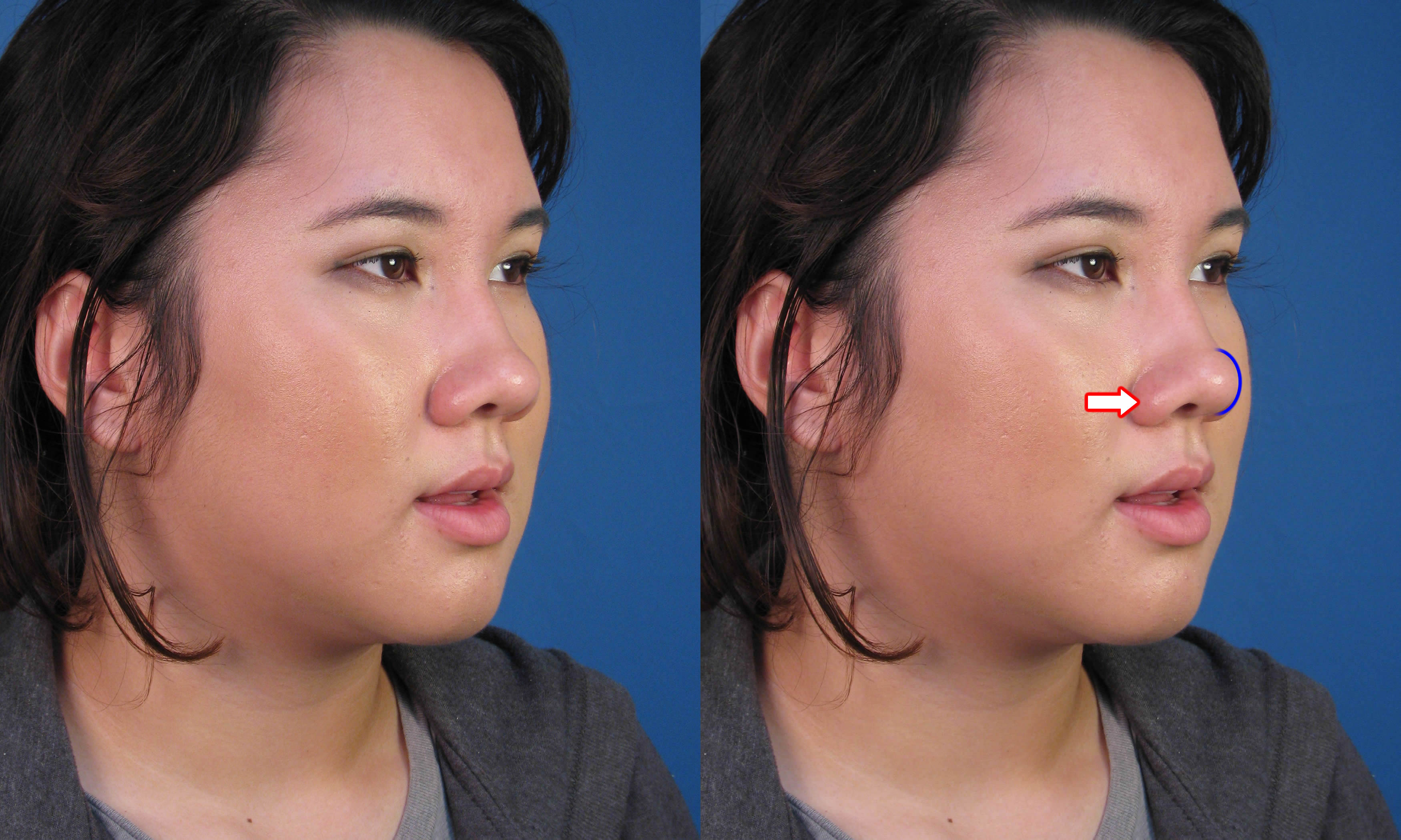 asian nose job before and after