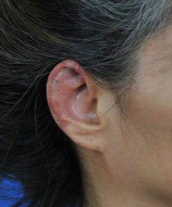Macrotia Scapha Ear Reduction Case Study San Diego CA