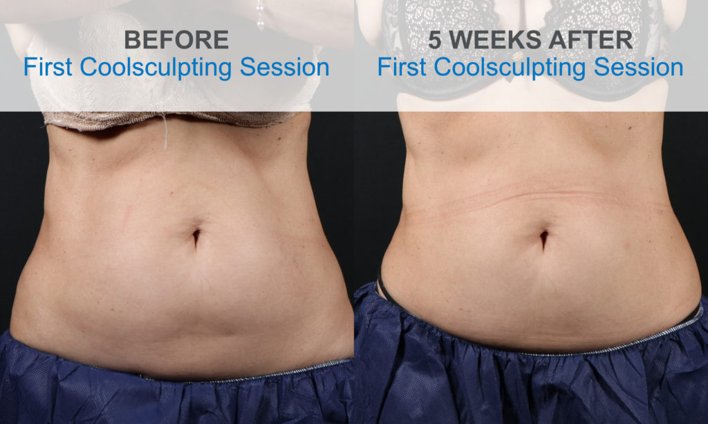 tummy tuck before and after pics