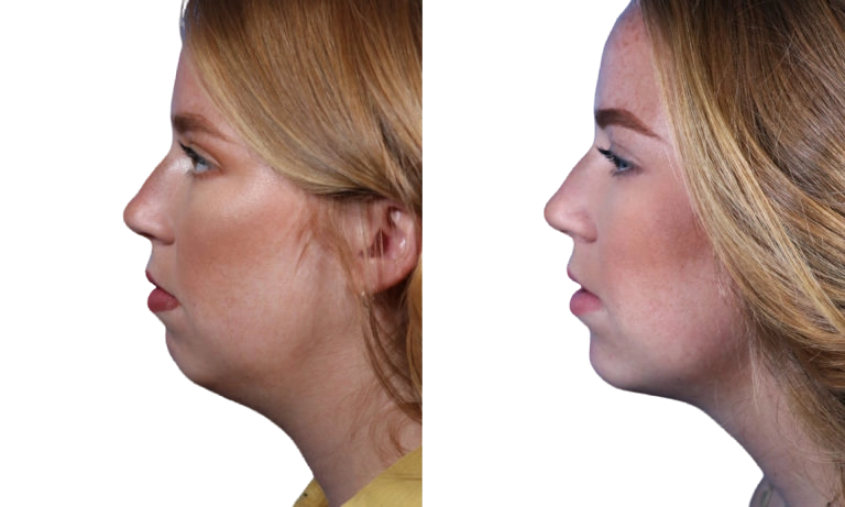 photo of a chin augmentation procedure