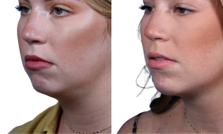 before photo of a chin augmentation procedure