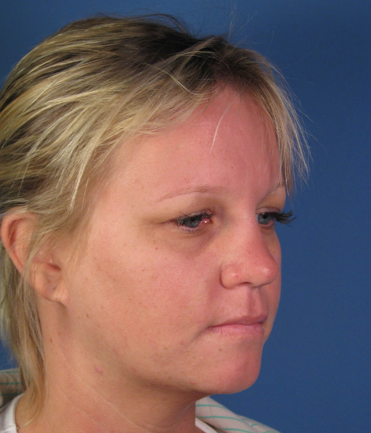 San Diego, CA Facial Scar Revision Reconstruction by Dr. John Hilinski