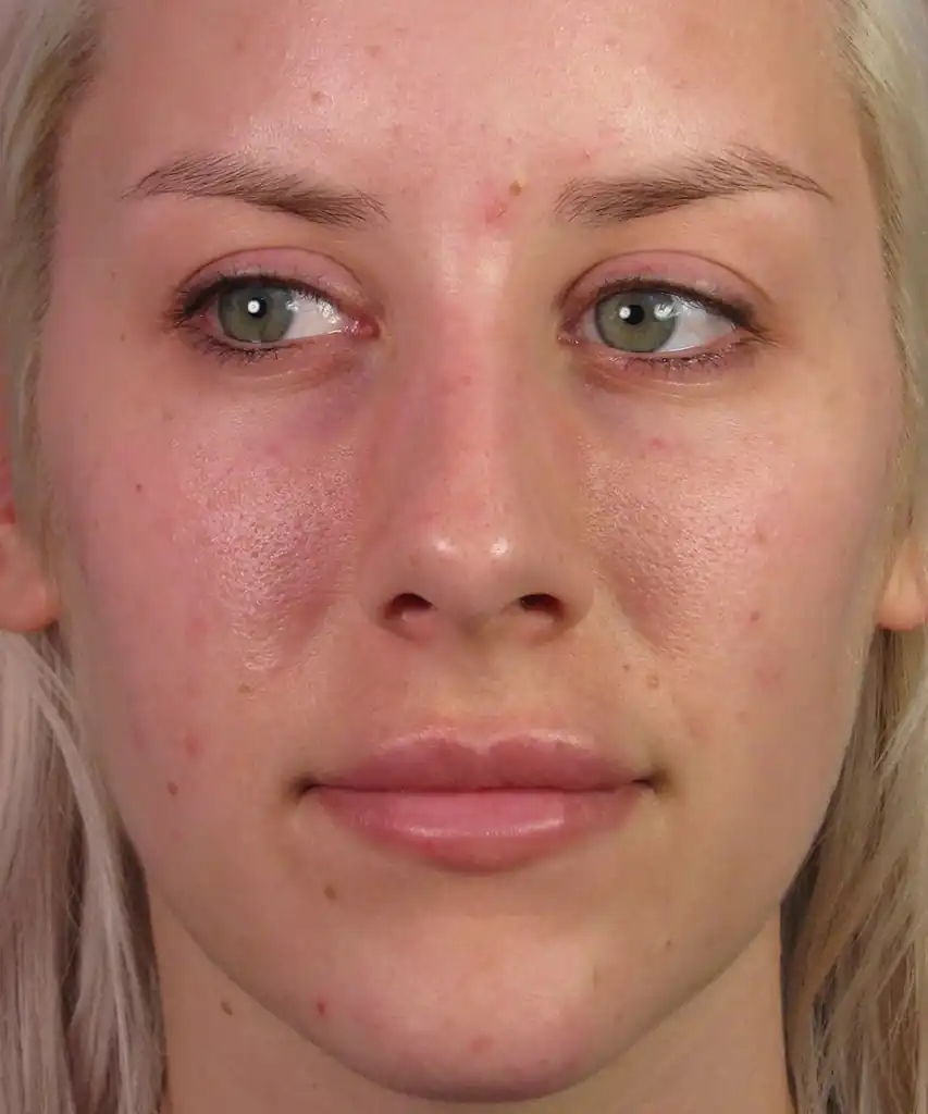 patient after restylane front