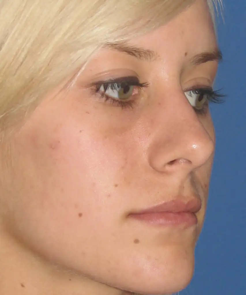 patient before restylane oblique side