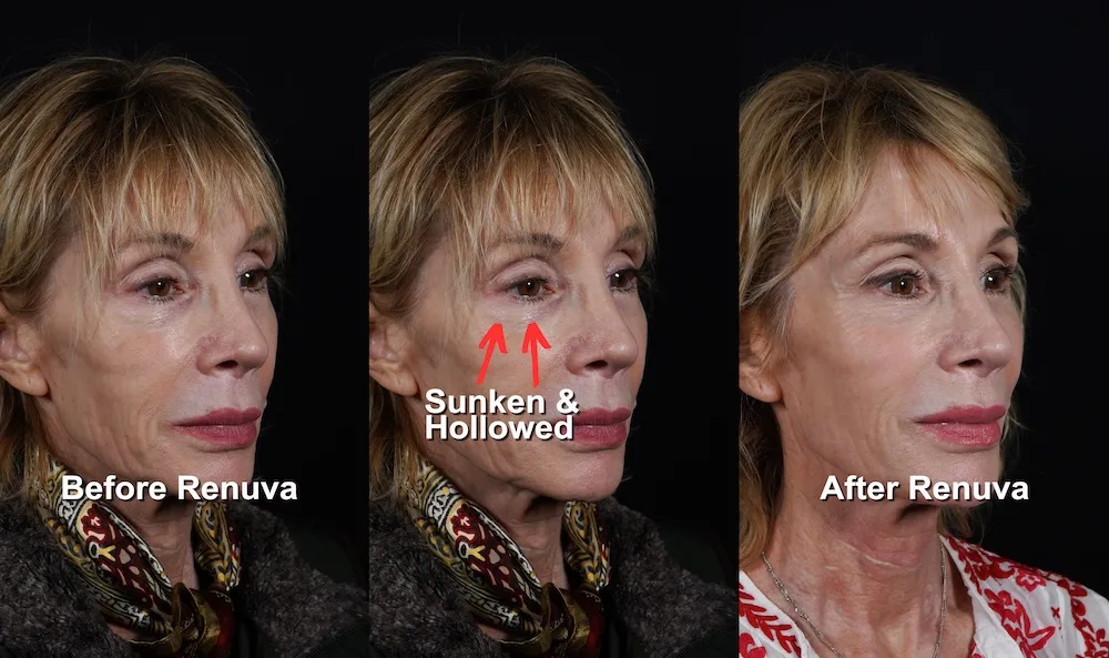 patient before and after renuva diagram